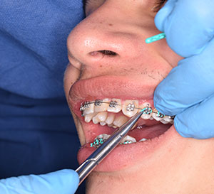 ¿Cuáles son las señales de que necesitas ortodoncia?